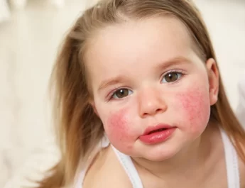 Alergias alimentarias y fiestas