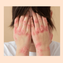 Psoriasis y Homeopatía