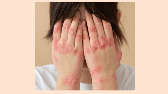 Psoriasis y Homeopatía