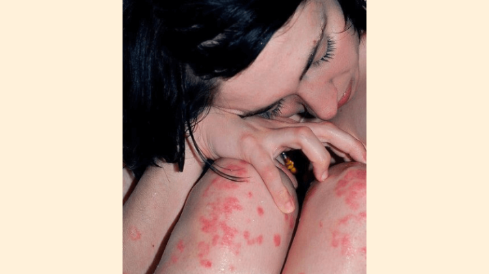 Psoriasis y Homeopatía